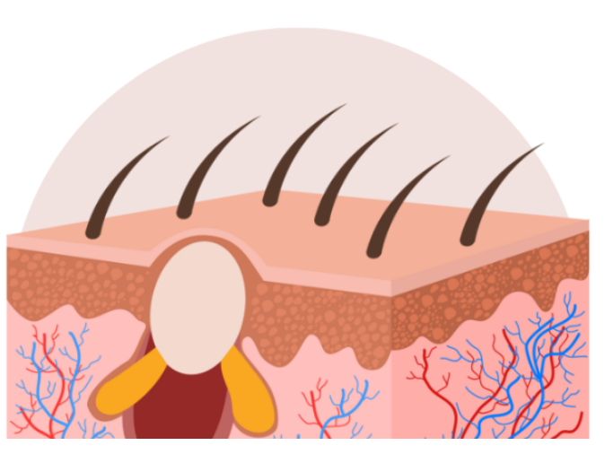 지방종이 주로 발생하는 부위