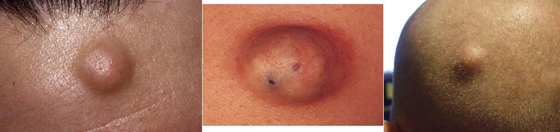 표피 낭종 예, 목, 가슴, 두피 부위