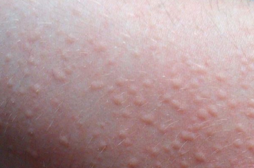 콜린성 두드러기 원인