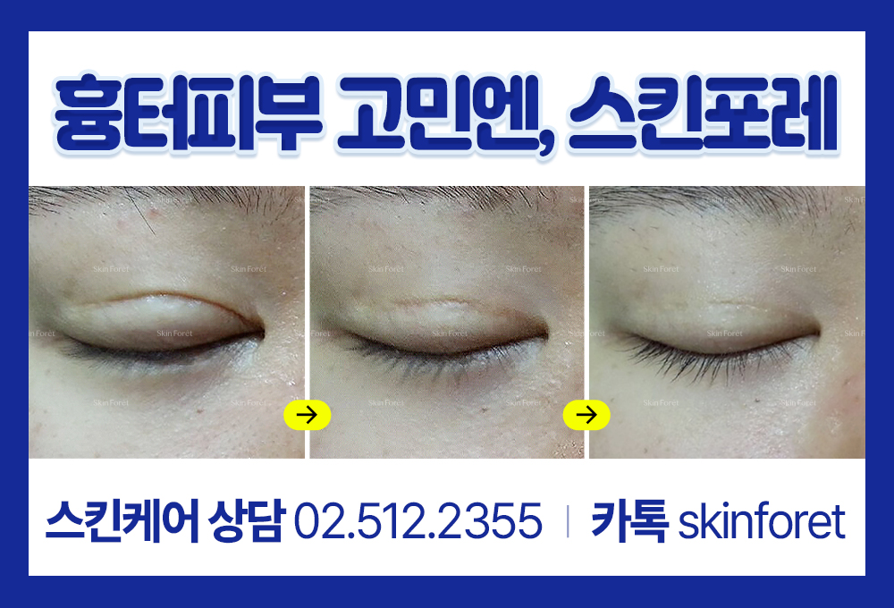 쌍수 다음 흉살과 소세지눈 skinforet 관리 실제 사례