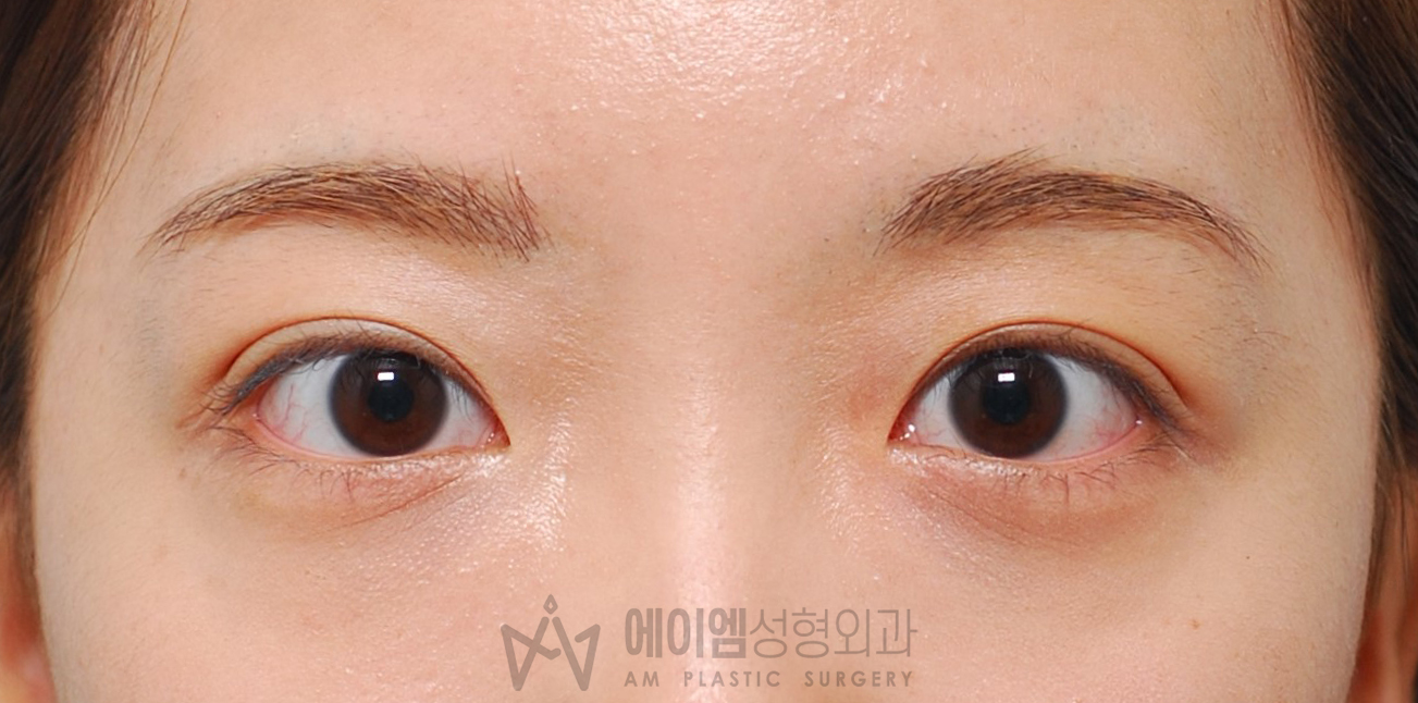 쌍꺼풀 풀림 절개법 교정 재수술 후 3개월