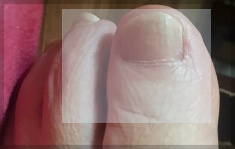 발톱무좀
