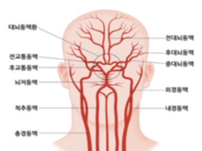 뇌출혈 전조증상 원인 예방법