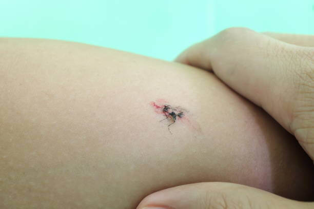 스키터증후군 성인 봉와직염으로 변하는 과정과 스키터 증후군 원인과 증상 치료 방법까지 알아봤습니다. 여름 뿐 아니라 가을모기도 매우 무서운 존재로 변해가고 있습니다. 모기 알레르기가 있다면 참고하시기 바랍니다.