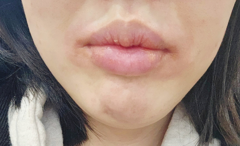 입술이 붓는 이유