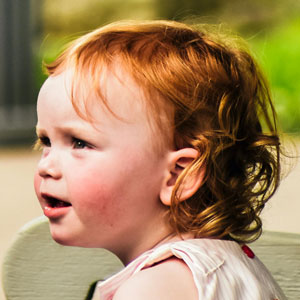 감염성 홍반 증상