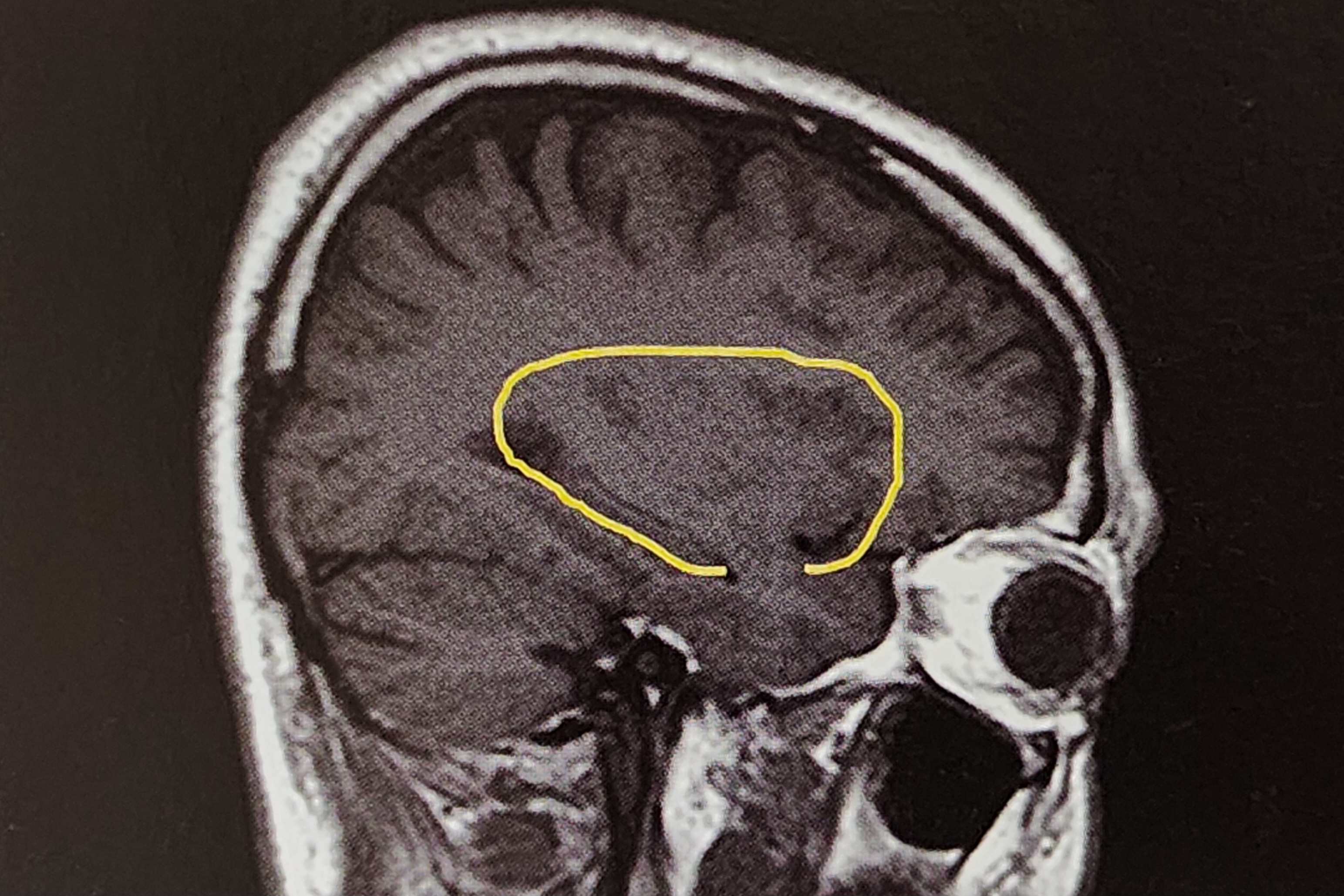 대뇌반구절제술(Hemispherectomy)