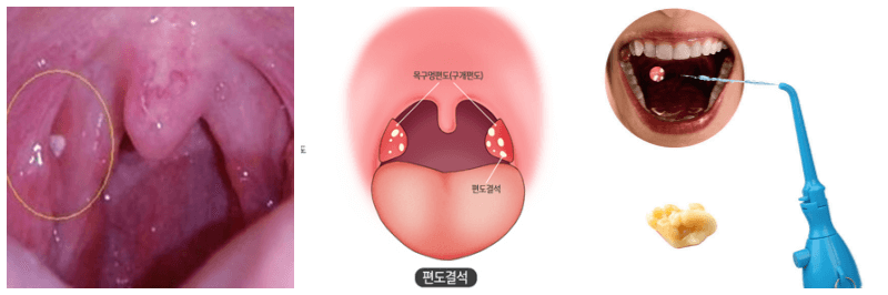편도, 편도결석, 편도결석 제거기 사진