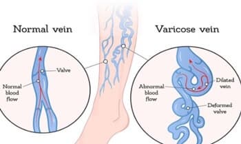 하지정맥류 자가 진단 초기 증상 좋은 운동 예방