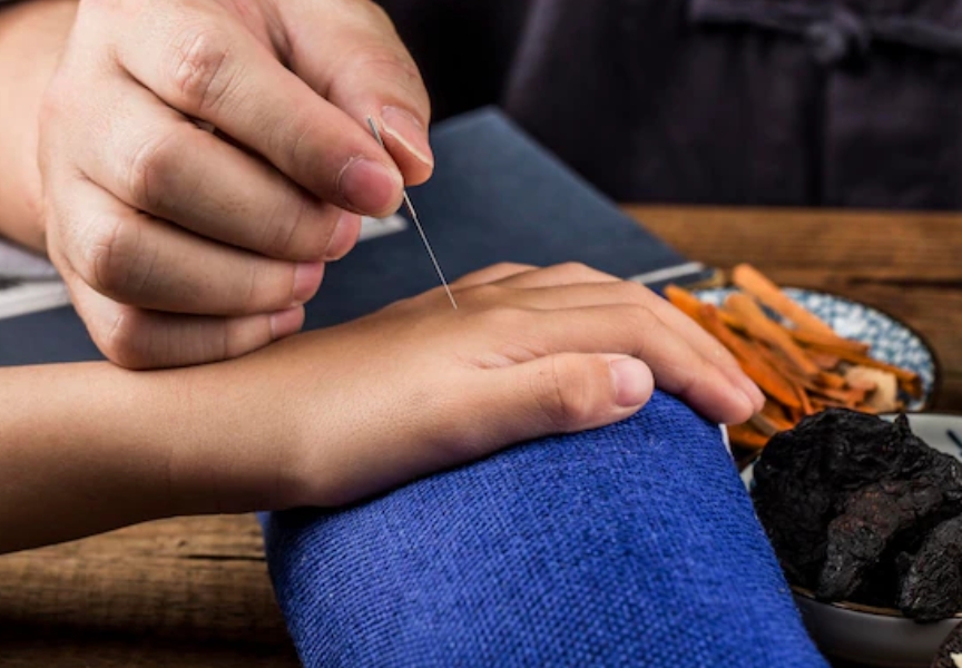 한의원에서 손등에 침을 맞고 있는 사진