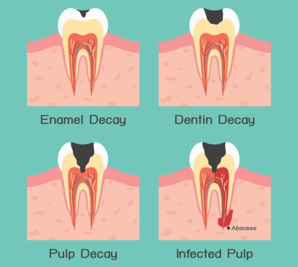 치근단 농양 원인
