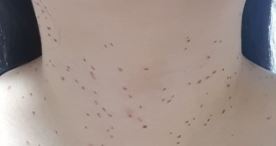 편평사마귀 없애는 방법