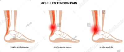 아킬레스건염