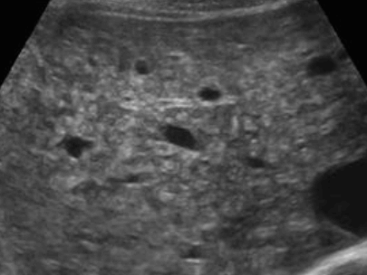 담도과오종 (Biliary harmatoma)