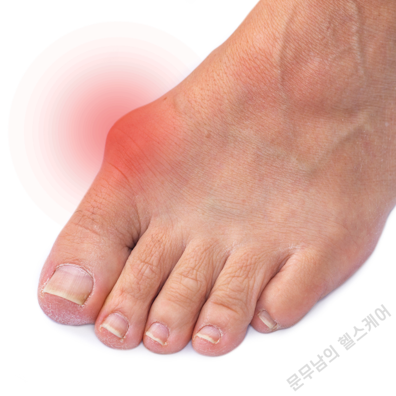 엄지발가락 옆 통증