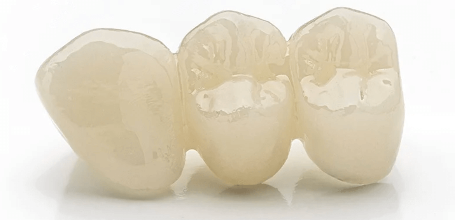 지르코니아 브릿지