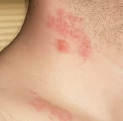 대상포진-초기증상-원인-건강