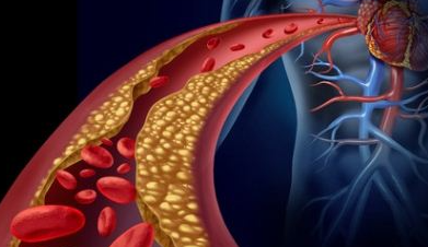 고지혈증-혈관-이미지