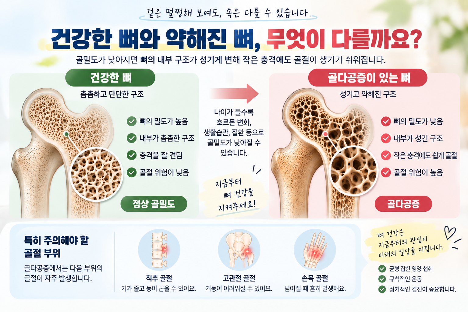 골밀도와 골절 위험을 설명하는 뼈 건강 그림