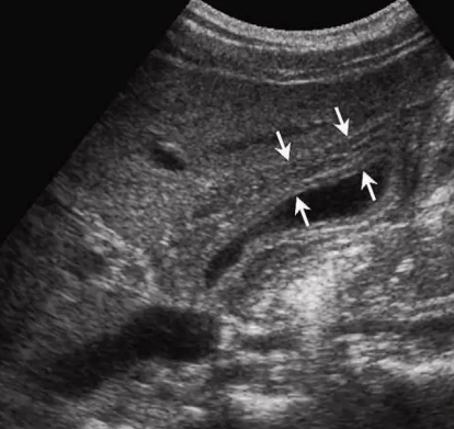 만성 담낭염 (Chronic cholecystitis)