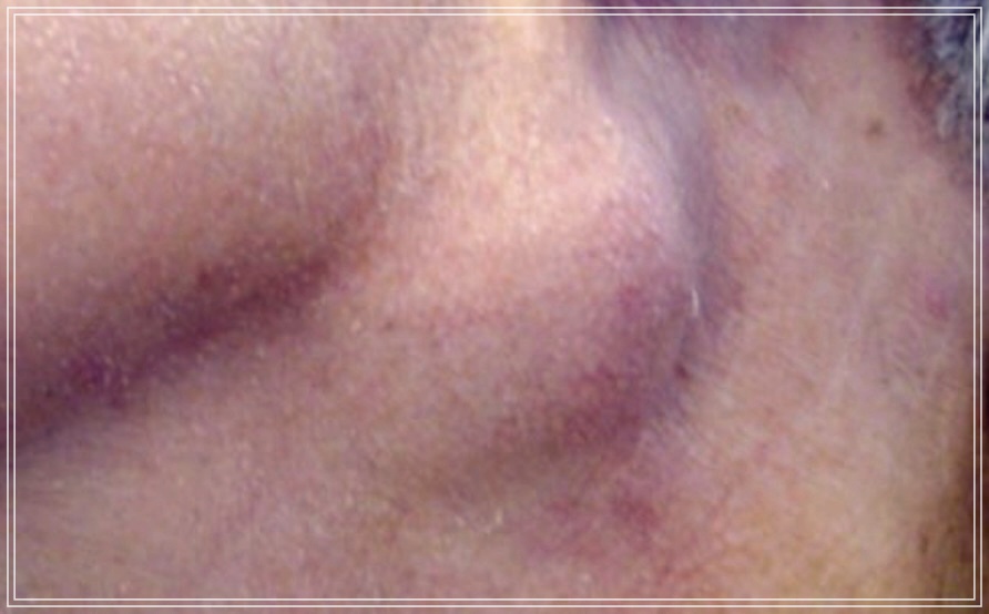 사타구니 몽우리 혹 빨리 없애는 방법