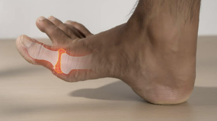 통풍 초기증상 치료법, 좋은 음식에 대한 모든 것 확인