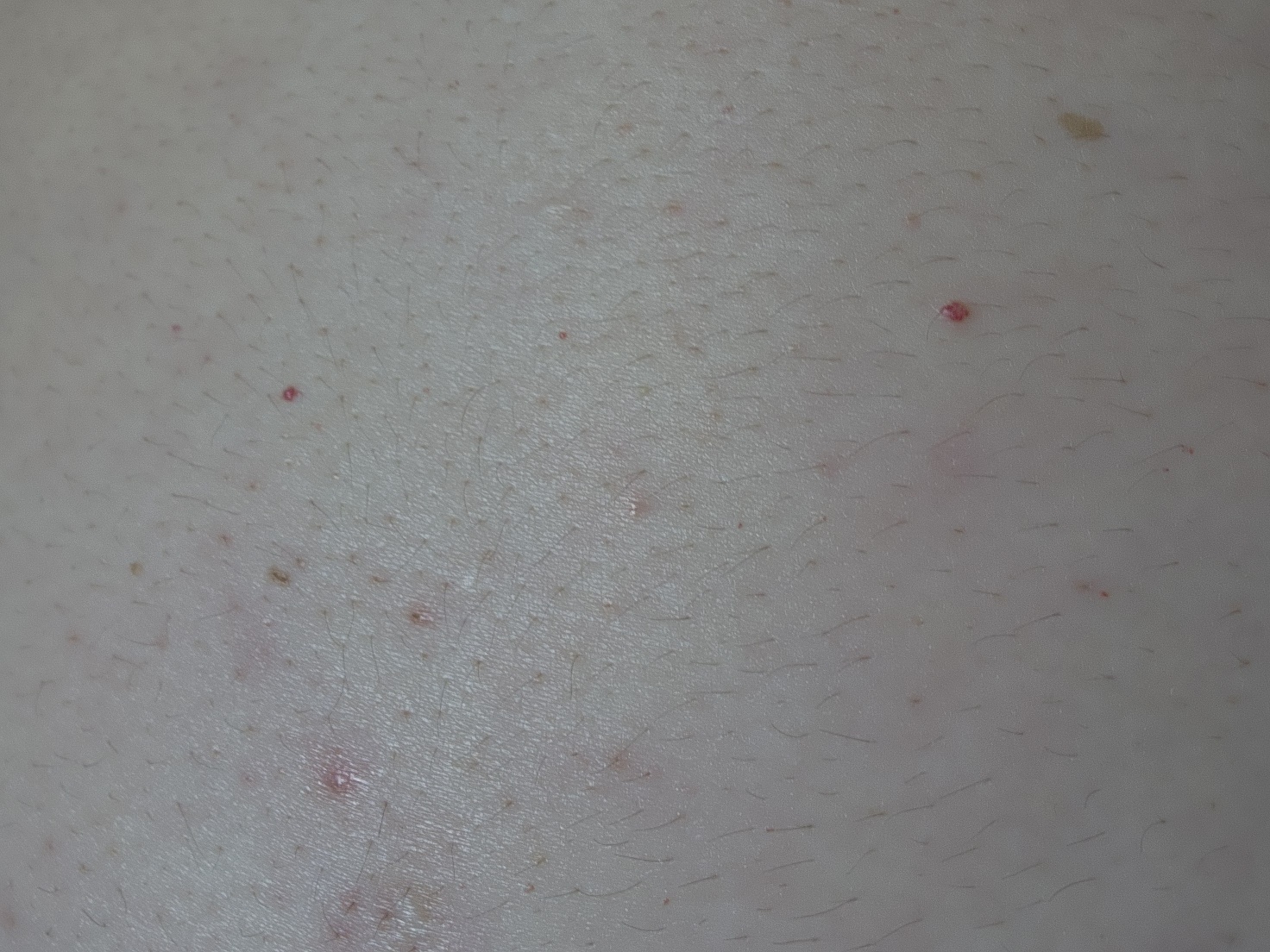 성인 피부의 일부에 작은 붉은 점 모양의 병변이 보이며, 체리 혈관종으로 의심되는 병변이 복부에 산재해 있다.