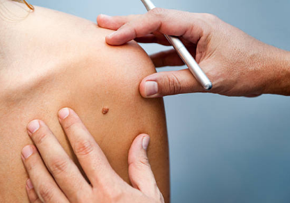 쥐젖 제거방법&amp;#44; 쥐젖이 생기는 이유&amp;#44; 제거 연고 총정리 (2024ver)