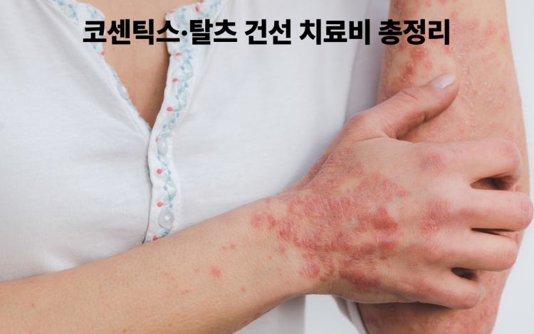 건선 코센틱스&middot;탈츠 치료 비용 총정리