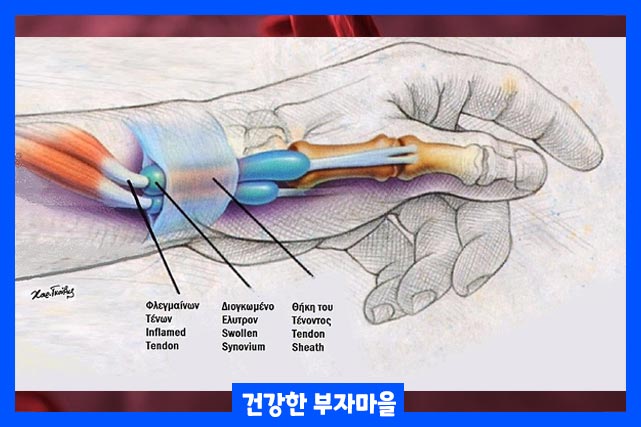 손가락 마디 통증 (관절염, 원인, 치료 방법) - 원인 4가지 - 2. 건초염 손가락 마디 통증 (관절염, 원인, 치료 방법) - 원인 4가지 - 2. 건초염