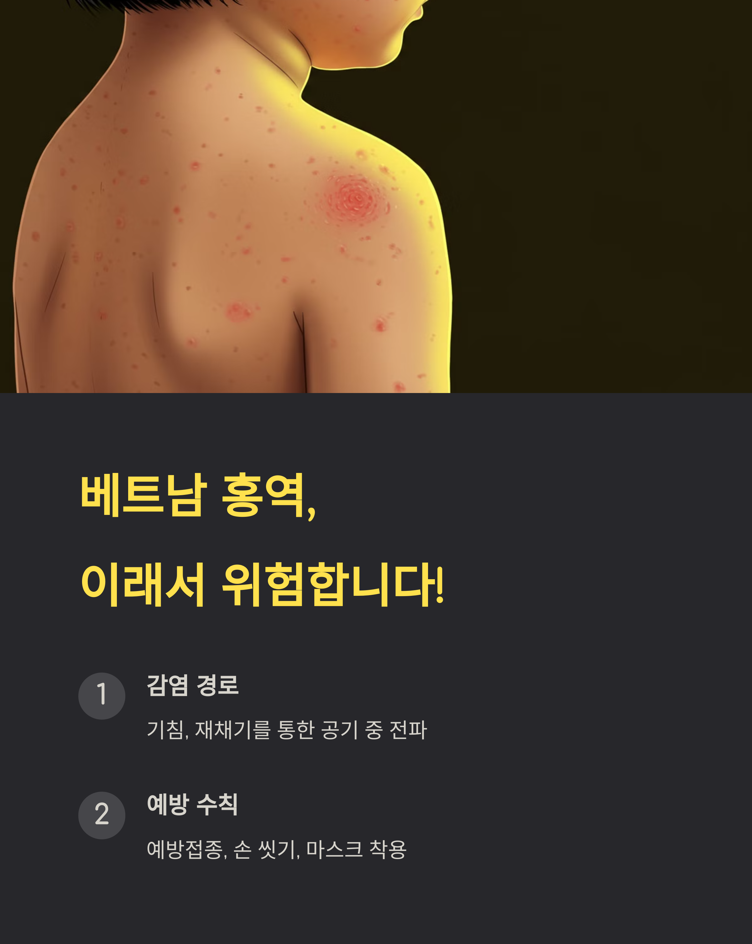 배트남 홍역 감염 경로와 예방 수칙