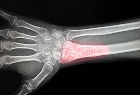 골다공증 증상, 수치, 골다공증에 좋은 음식 총정리 (2024ver)
