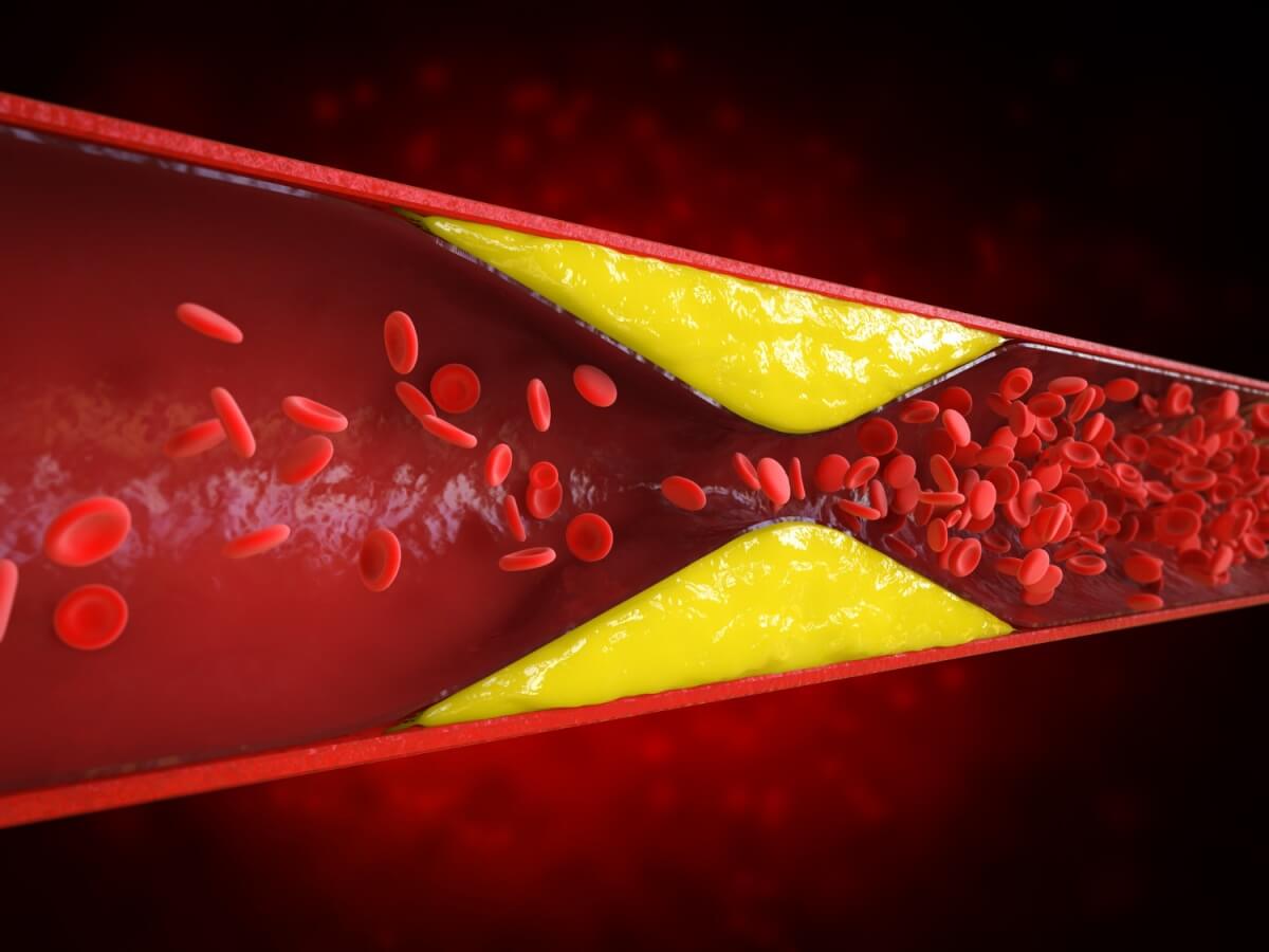 LDL콜레스테롤로인해-동맥벽에-쌓인-플라크