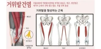 거위발 건염 원인과 증상 무릎 안쪽 통증 치료법 정리_21