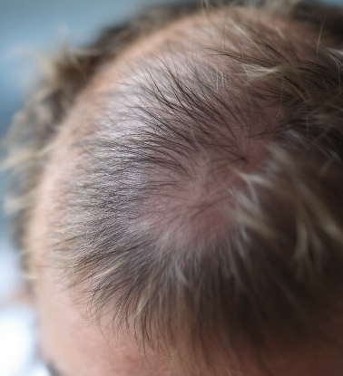 탈모치료&amp;#44; 시작 시기만 알아도 결과가 달라진다 (탈모치료 시기 총정리)