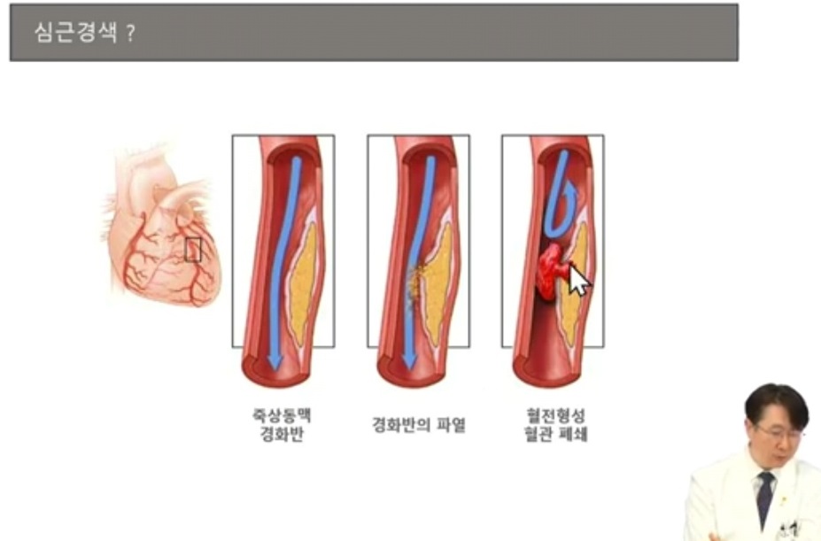 EBS귀하신몸-혈관-이상엽-교수