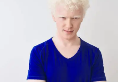 백반증 초기증상 15