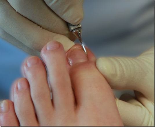 라셀턴 발톱 세럼 사용법과 주의사항