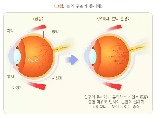 비문증과 파인애플 효과
