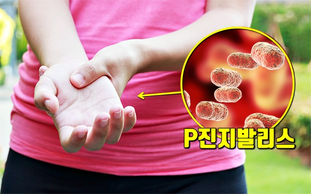 류머티스 관절염,잇몸병,치주염,풍치,팁줌 매일꿀정보