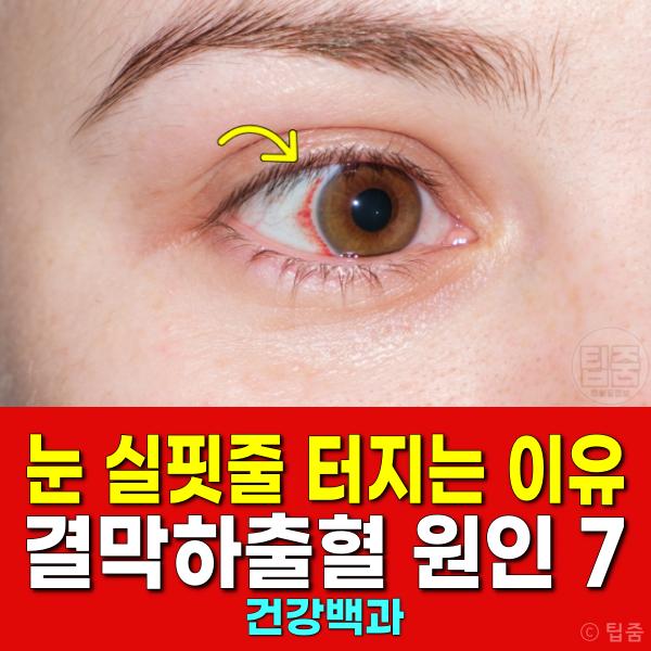 눈 실핏줄 터지는 이유 눈혈관 터짐 결막하출혈 원인