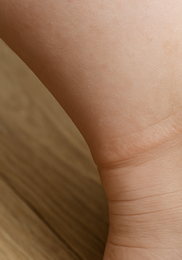 다리 보라색실핏줄