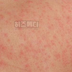 쯔쯔가무시 증상