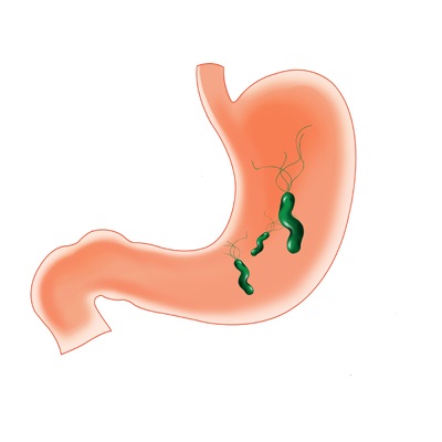 위암-유발- 헬리코박터균-감염-경로-증상-검사-하는- 방법-치료-하는-방법