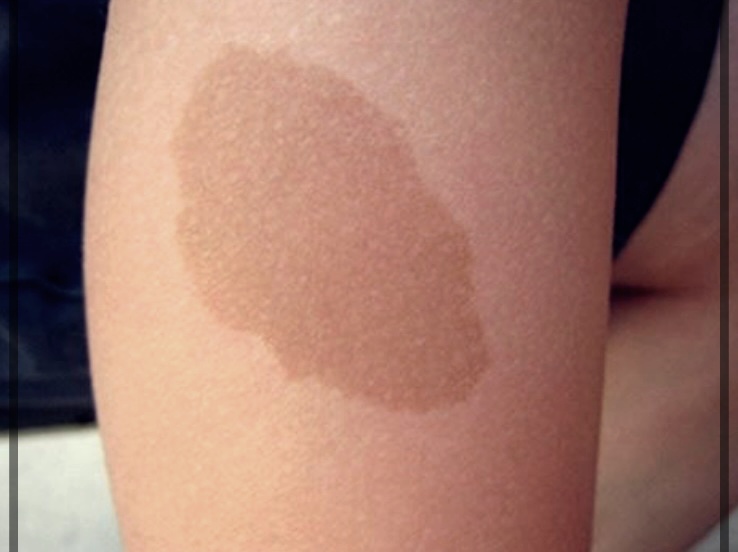 후천성 오타모반 이란?기미. 주금깨 주범.