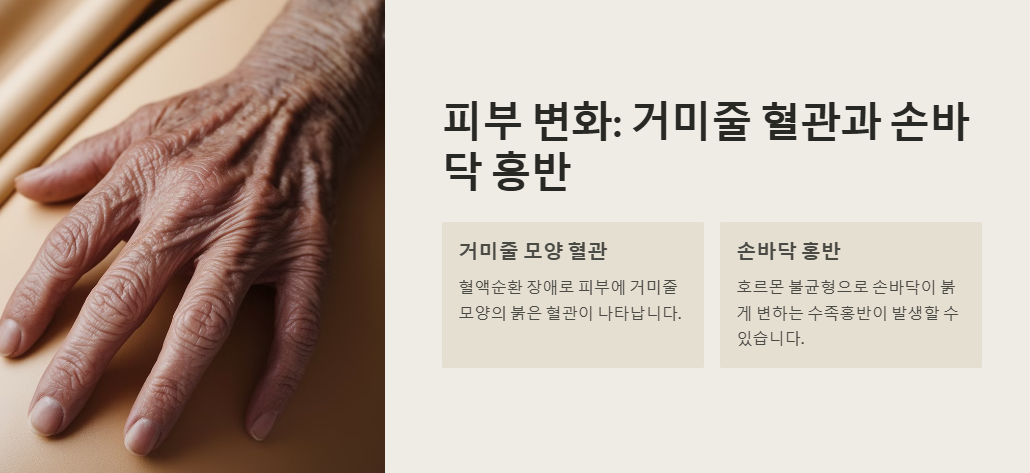 거미줄 혈관과 손바닥 홍반