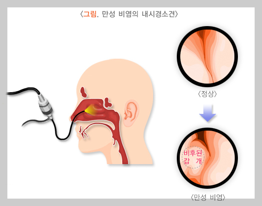 비염