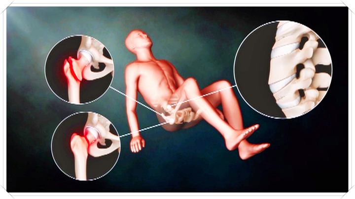 명의-고관절-손상-예시