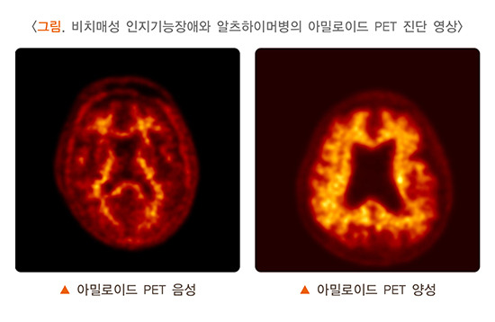 아밀로이드 PET 영상 해석
