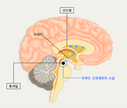 파킨슨병 초기증상